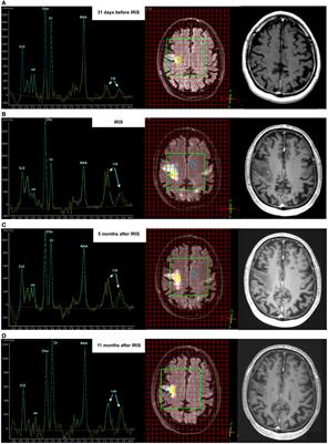 Insight into Metabolic 1H-MRS Changes in Natalizumab Induced Progressive Multifocal Leukoencephalopathy Brain Lesions